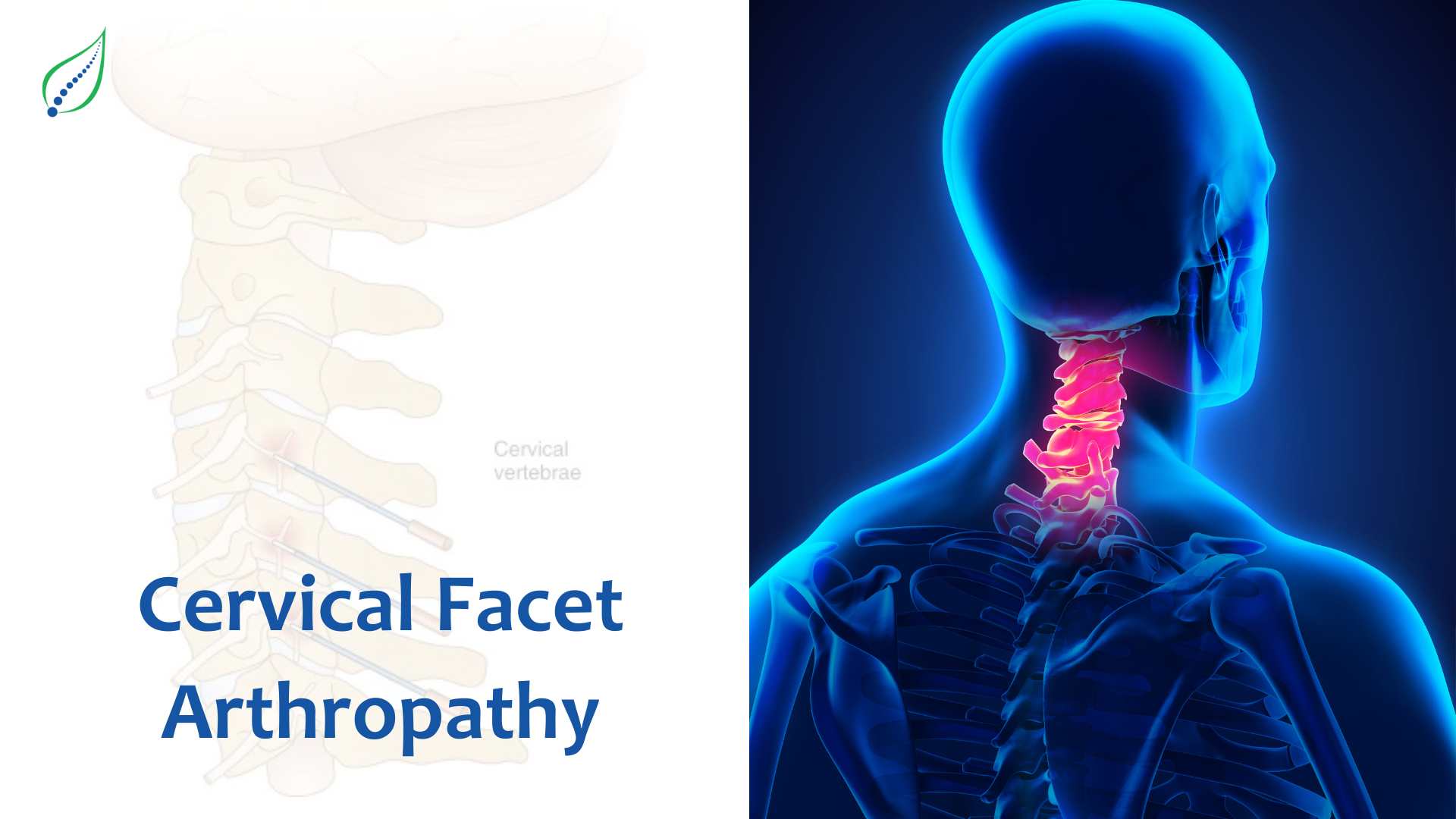 Cervical Facet Arthropathy - Causes, Symptoms, and Treatments